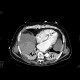Hepatocellular carcinoma, ruptured, hemoperitoneum: CT - Computed tomography